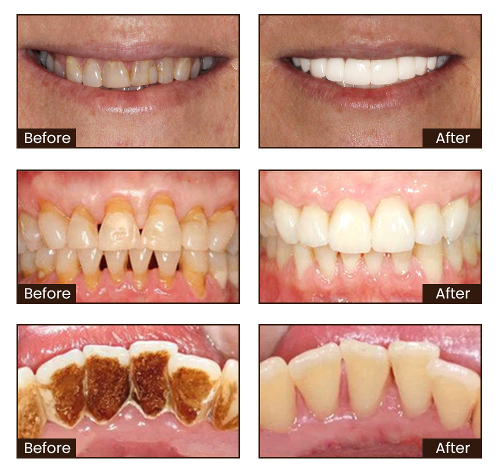 [Buy 1 Get 1 Free] Niacinamide Whitening Toothpaste - 7 Days Intense Whitening