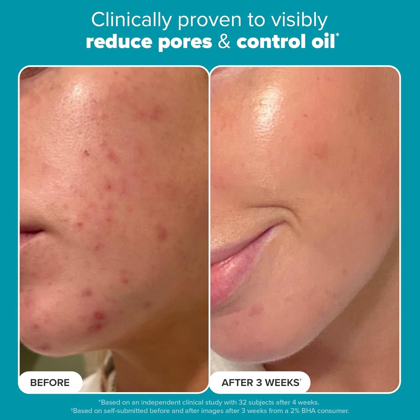（🔥LAST DAY SALE-61% OFF) LOVILDS™ Salicylic Acid Serum