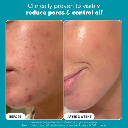 （🔥LAST DAY SALE-61% OFF) LOVILDS™ Salicylic Acid Serum