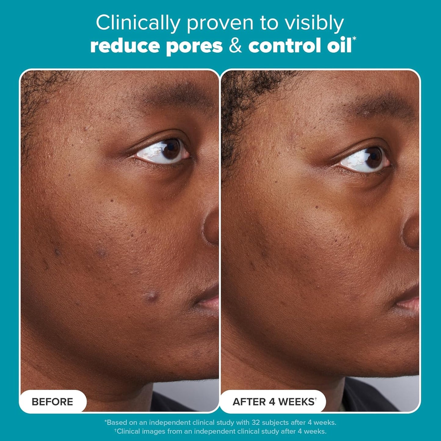 （🔥LAST DAY SALE-61% OFF) LOVILDS™ Salicylic Acid Serum