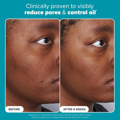 （🔥LAST DAY SALE-61% OFF) LOVILDS™ Salicylic Acid Serum